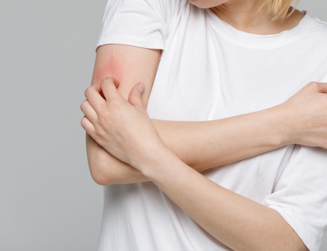 Eczema itch on arm
